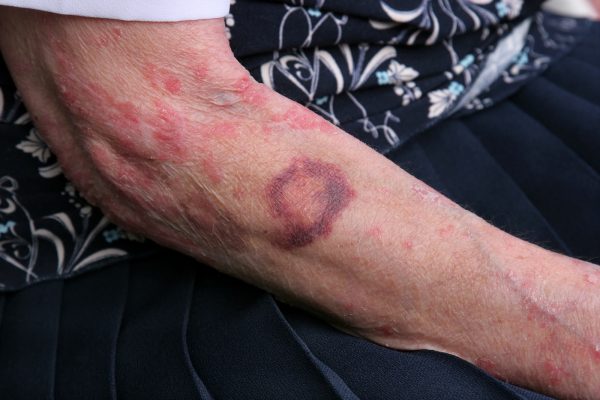 Marks on a victim's arm show a need to call a personal injury lawyer Sugar Land, TX after dog bite accidents.